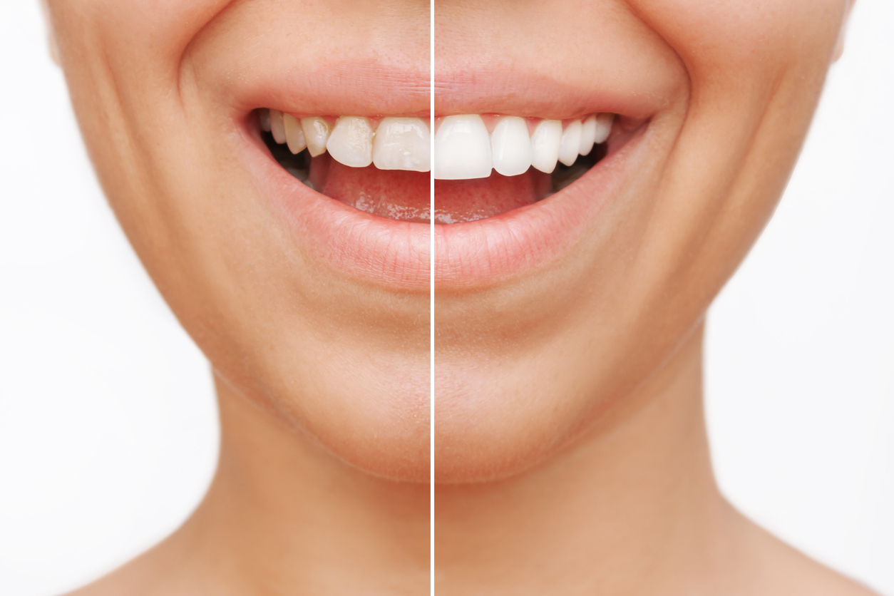Smile Concept : une innovation Geneva Dental Clinic