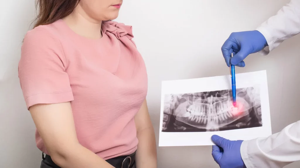 Comment gérer la douleur après l’extraction des dents de sagesse