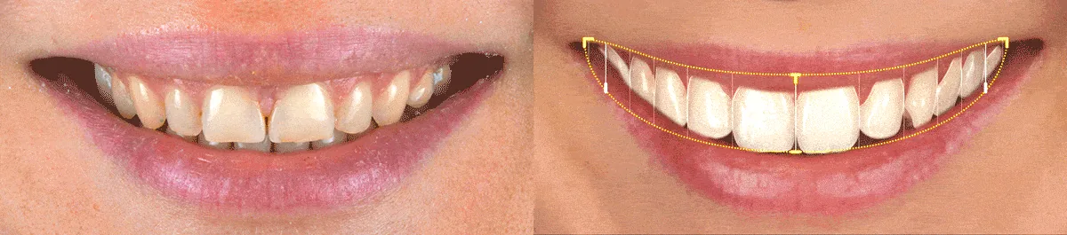 Sourire avant la pose des facettes, à côté de la simulation du sourire projeté