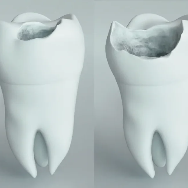 Dentisterie préventive, molaires atteintes de caries à différents stades