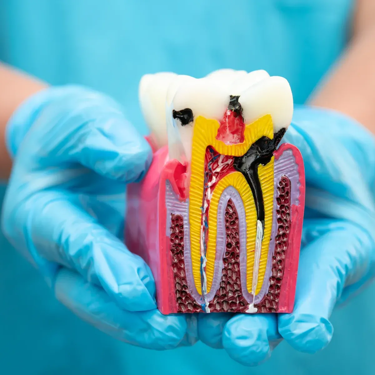 Endodontie, modèle anatomique d’une dent en coupe montrant le nerf et les racines