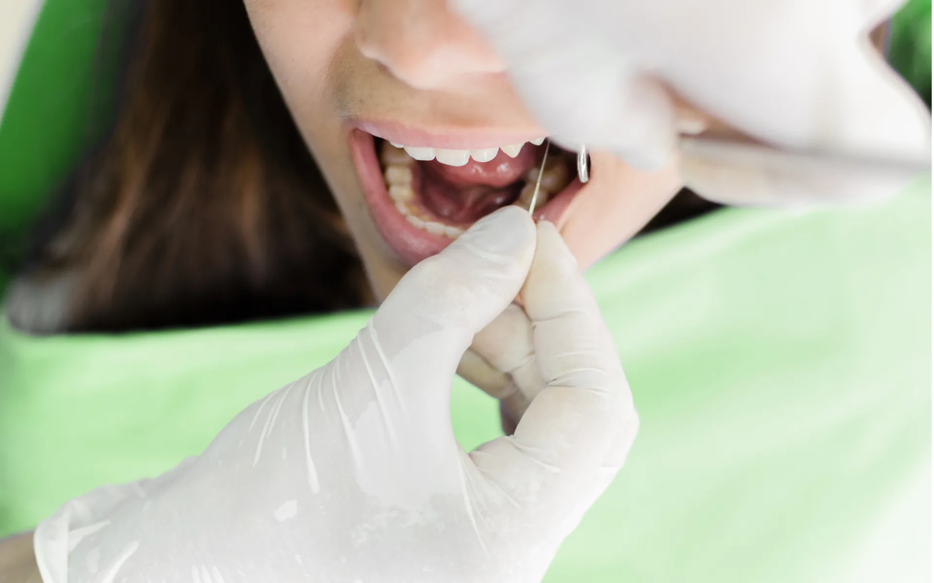 Traitement de racine en cours sous champ opératoire, instruments endodontiques en main
