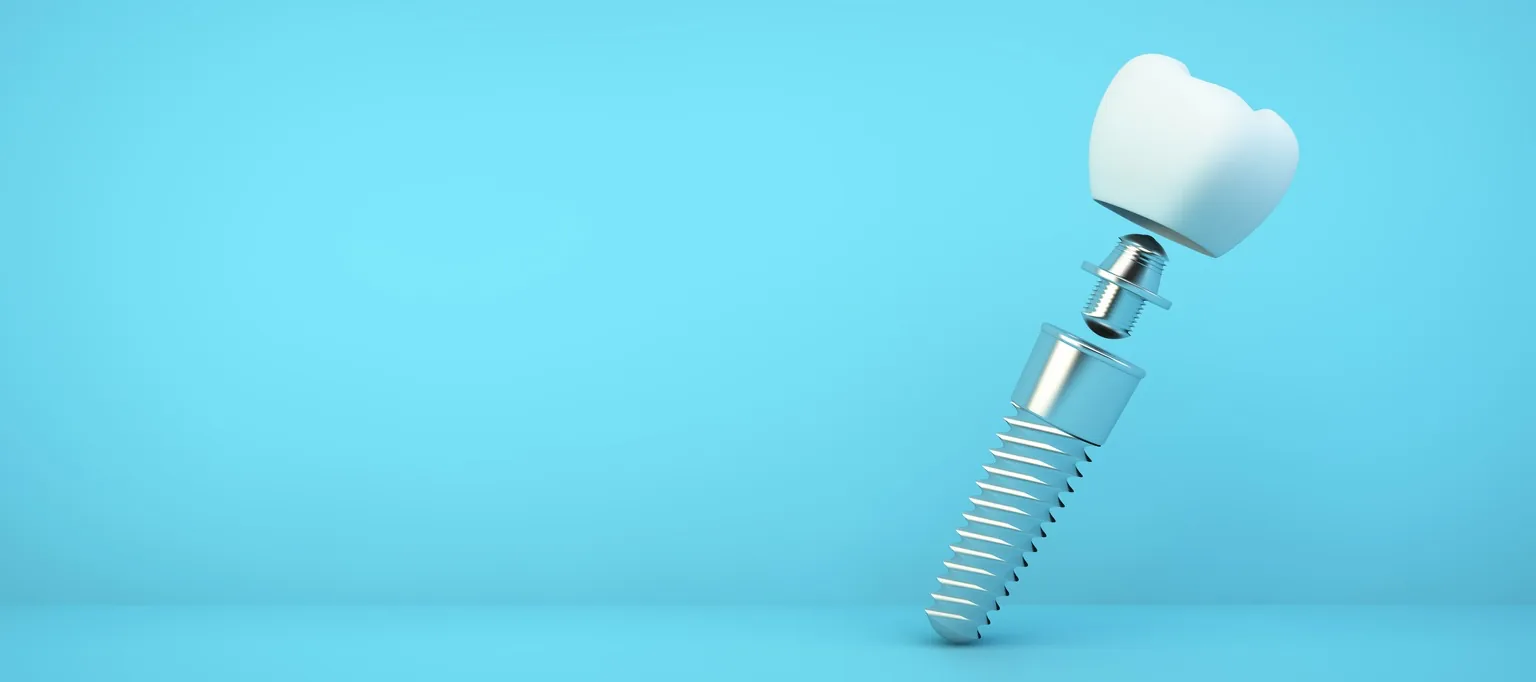 Illustration des composants d’un implant dentaire sur fond bleu