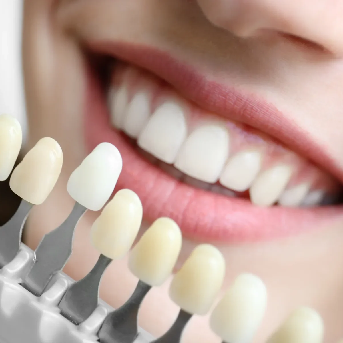 Blanchiment dentaire, teintier comparé à la couleur des dents d’une patiente