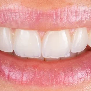 Smile Concept, sourire en gros plan après une réhabilitation esthétique
