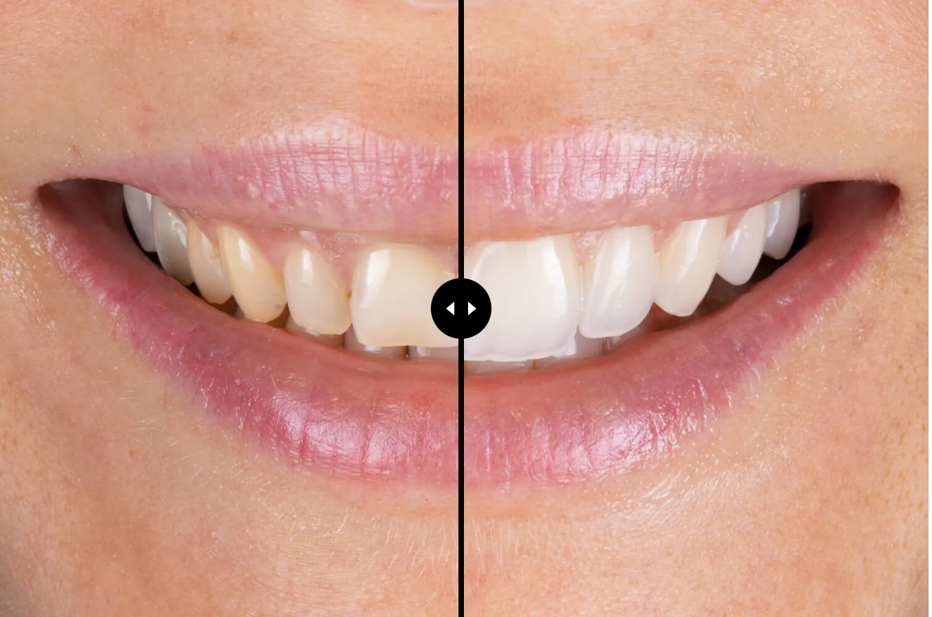 Comparaison avant et après une réhabilitation de sourire Smile Concept, le même sourire présenté en deux moitiés