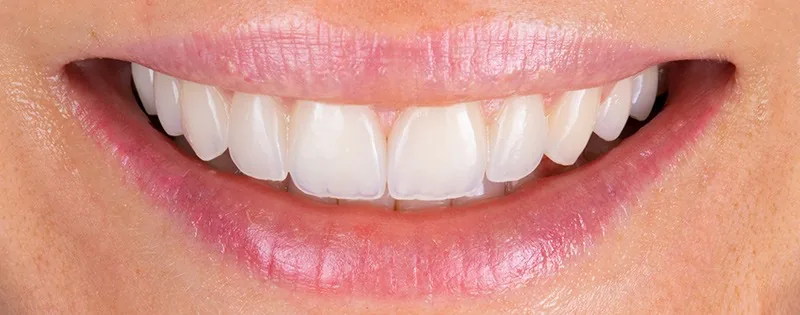 Sourire définitif après la pose des facettes Smile Concept